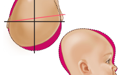 Skævt og fladt baghoved