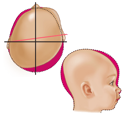 Skævt og fladt baghoved